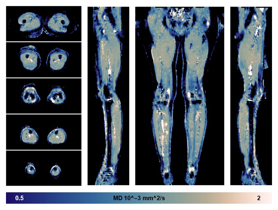 IVIM corrected whole leg muscle mean diffusivity obtained from diffusion tensor imaging.